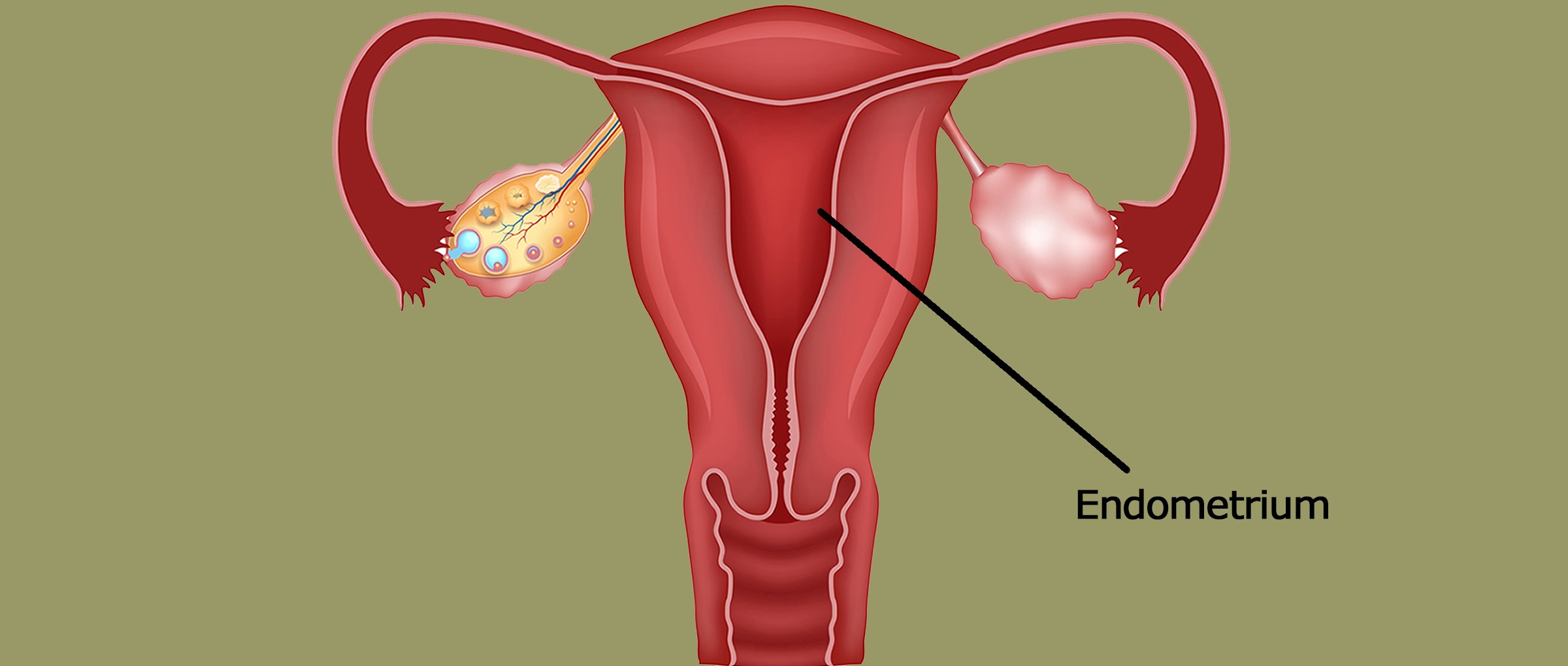 Аблация эндометрия