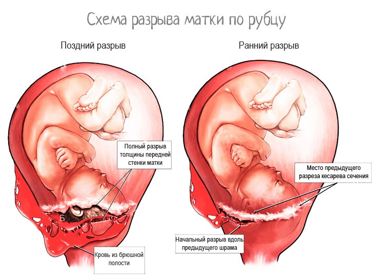 Несостоятельность рубца на матке после КС - Гинекологический центр Женская клиника