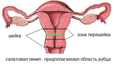 Как лечить гипертрофический рубец?