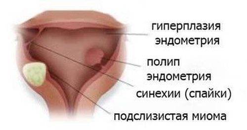 Аденомиоз матки