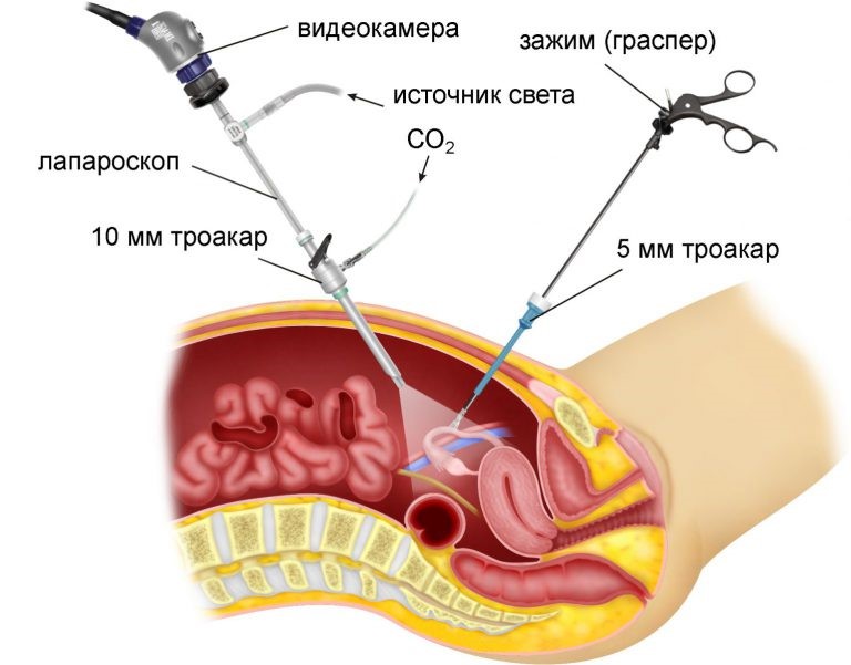 Кольпоскопия шейки матки