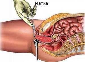 Операция по удалению матки