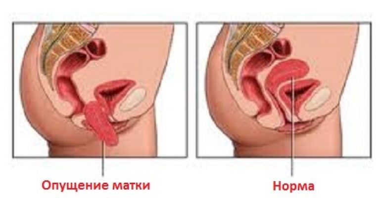 Удаление матки. Разговор без табу