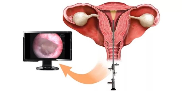 Выскабливание стенок полости матки