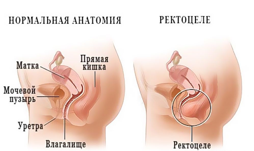 Задняя кольпорафия