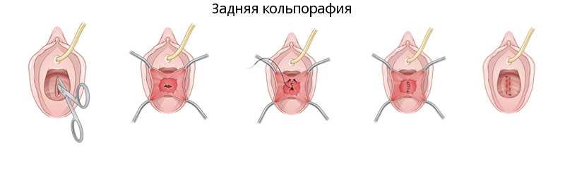 Задняя кольпорафия