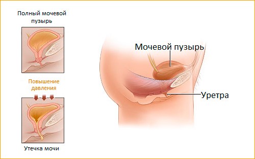 Лечение недержания мочи