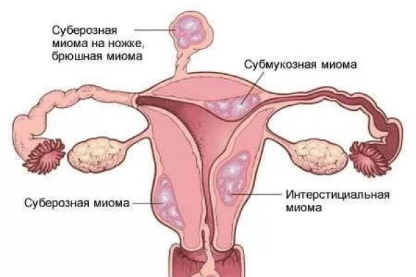 Диагностика и лечение миомы матки (Александров)