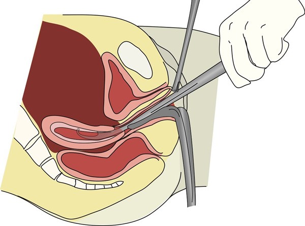 Выскабливание полости матки: показания, подготовка к процедуре