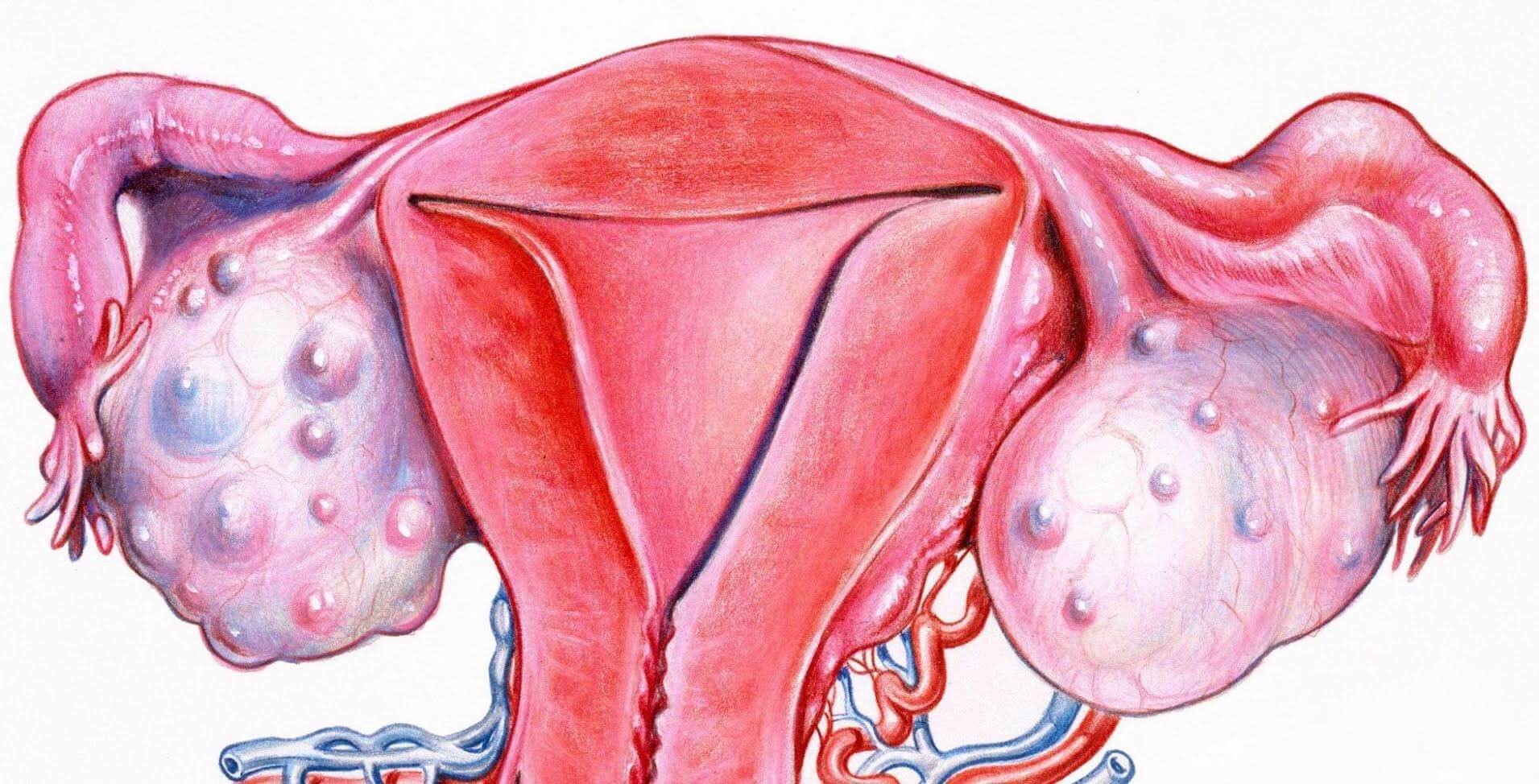 Quistes endometriosicos