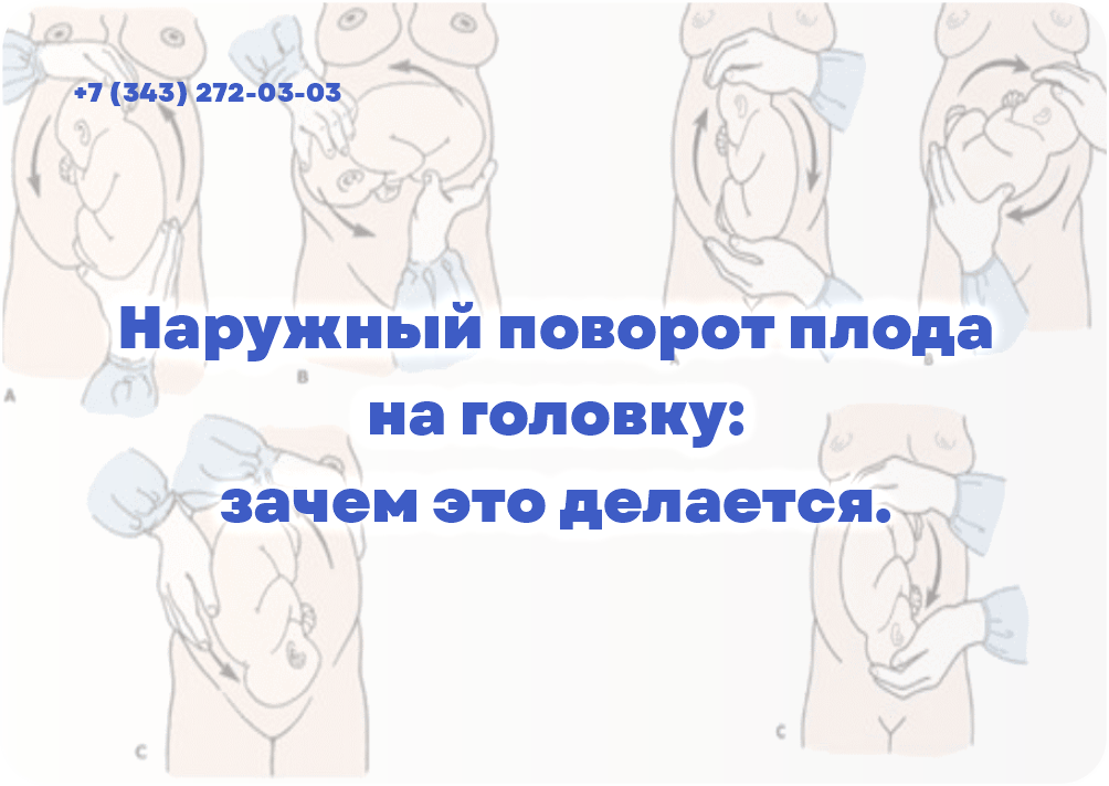 Наружный поворот плода на головку: зачем это делается.