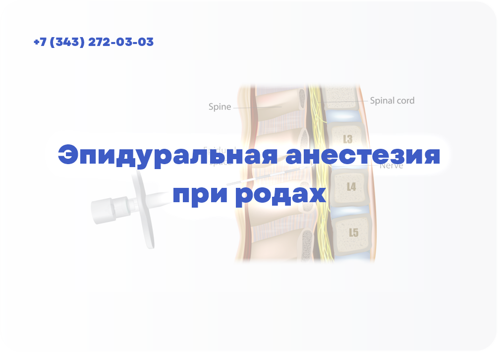 Эпидуральная анестезия при родах 