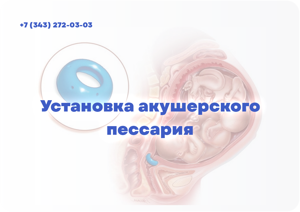 Установка акушерского пессария