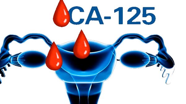 Онкомаркер СА 125 и его норма у женщин при кисте яичника