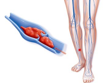 Генетический анализ: риск развития венозных тромбозов | Каталог анализов  медицинской лаборатории ЭндоМедЛаб (г. Москва, м. Дмитровское, м. Борисово)