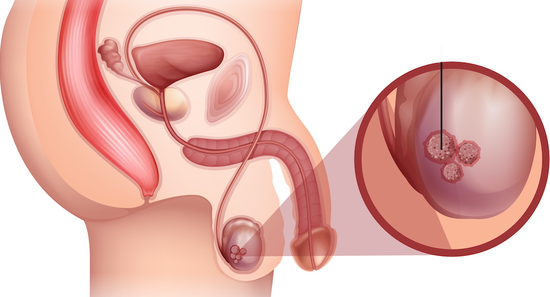 Алгоритмы диагностики и лечения рака яичка от референс-центра по  злокачественным урологическим опухолям.