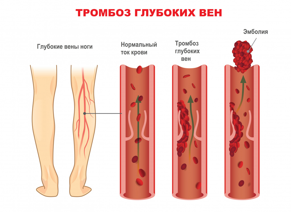 Тромбофилия - причины появления, симптомы заболевания, диагностика и  способы лечения