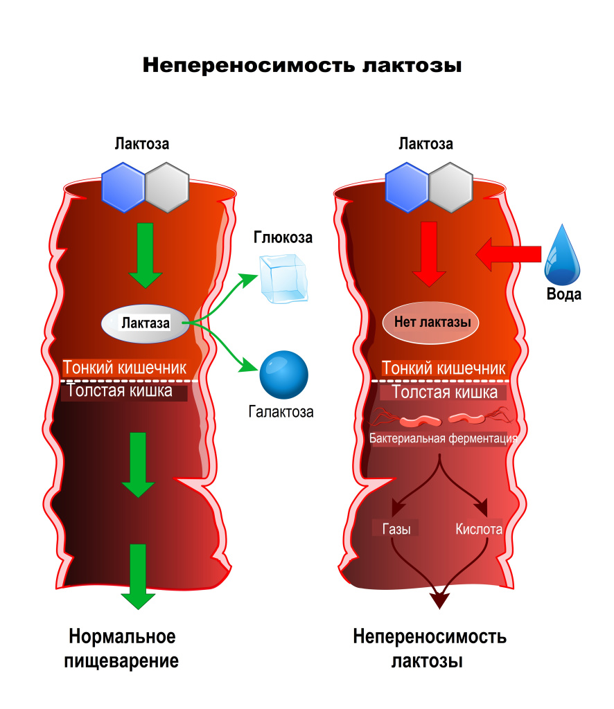 Непереносимость лактозы - причины появления, симптомы заболевания,  диагностика и способы лечения
