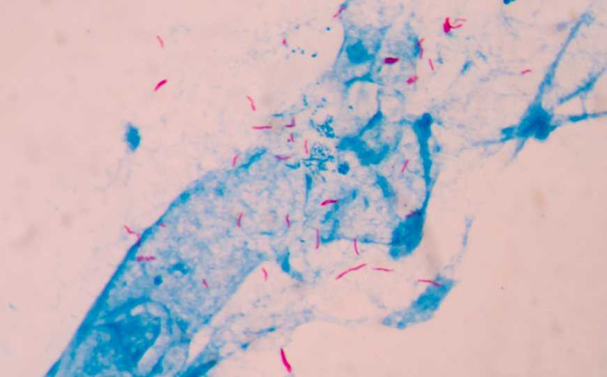 CRISPR-тест на ДНК микобактерии в крови подходит для пациентов с ВИЧ — PCR News