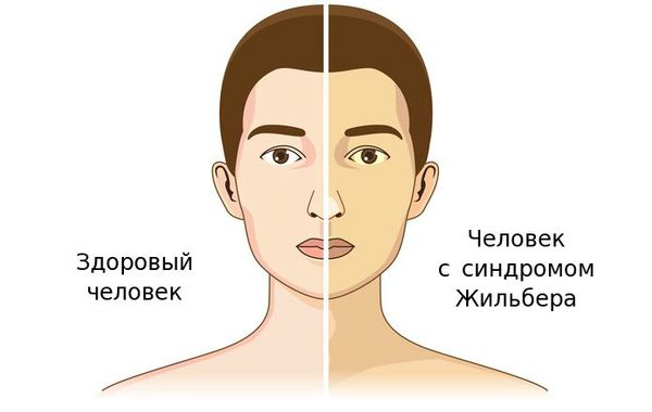 Все о синдроме Жильбера / Блог / Клиника ЭКСПЕРТ