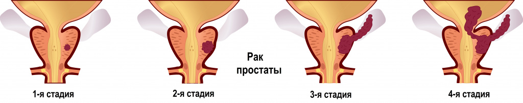 Анализ на ПСА общий и свободный, показания к назначению, правила подготовки  к сдаче анализа, расшифровка результатов и показатели нормы.
