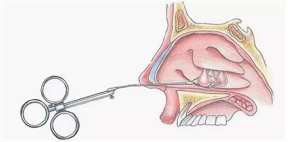 Полип Носа Симптомы Фото