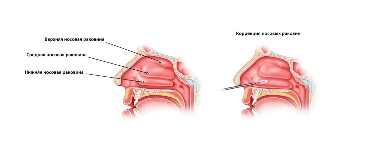 Вазотомия Нижних Носовых Раковин Цена Москва
