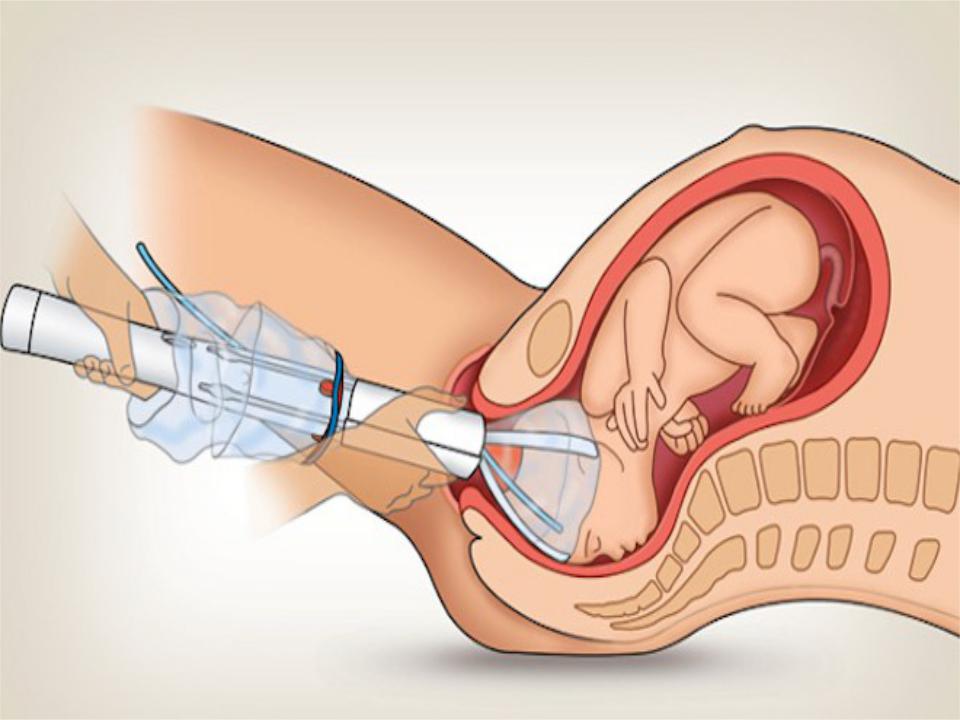 Вакуум экстракция плода: показания, последствия для матери и ребёнка