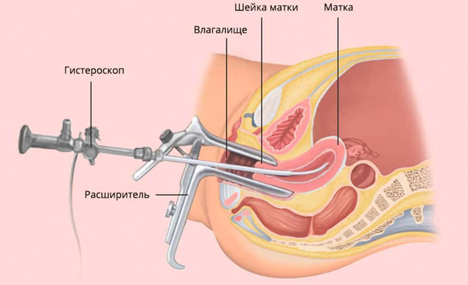 Удаление яичников во время операции по удалению матки - Dr_Popkov