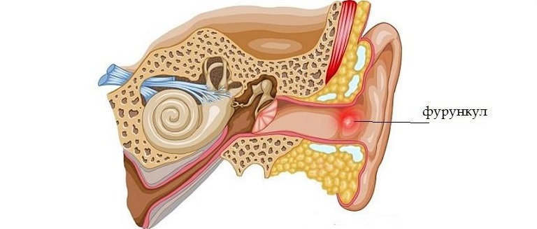 Фурункулез